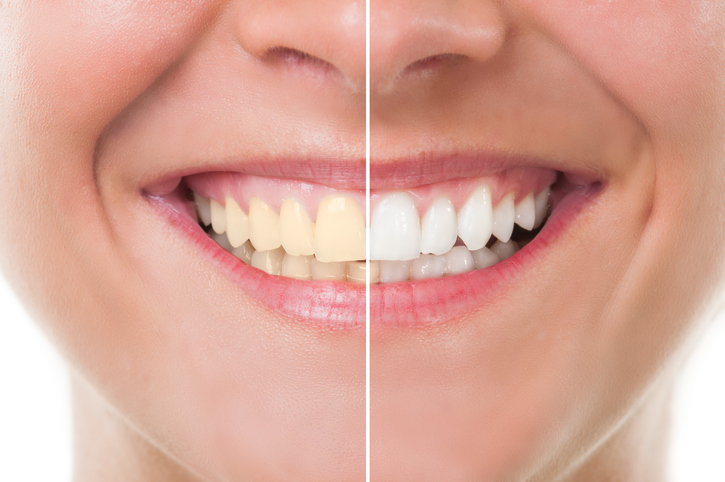 El Color natural de los dientes. ¿Por qué son blancos?
